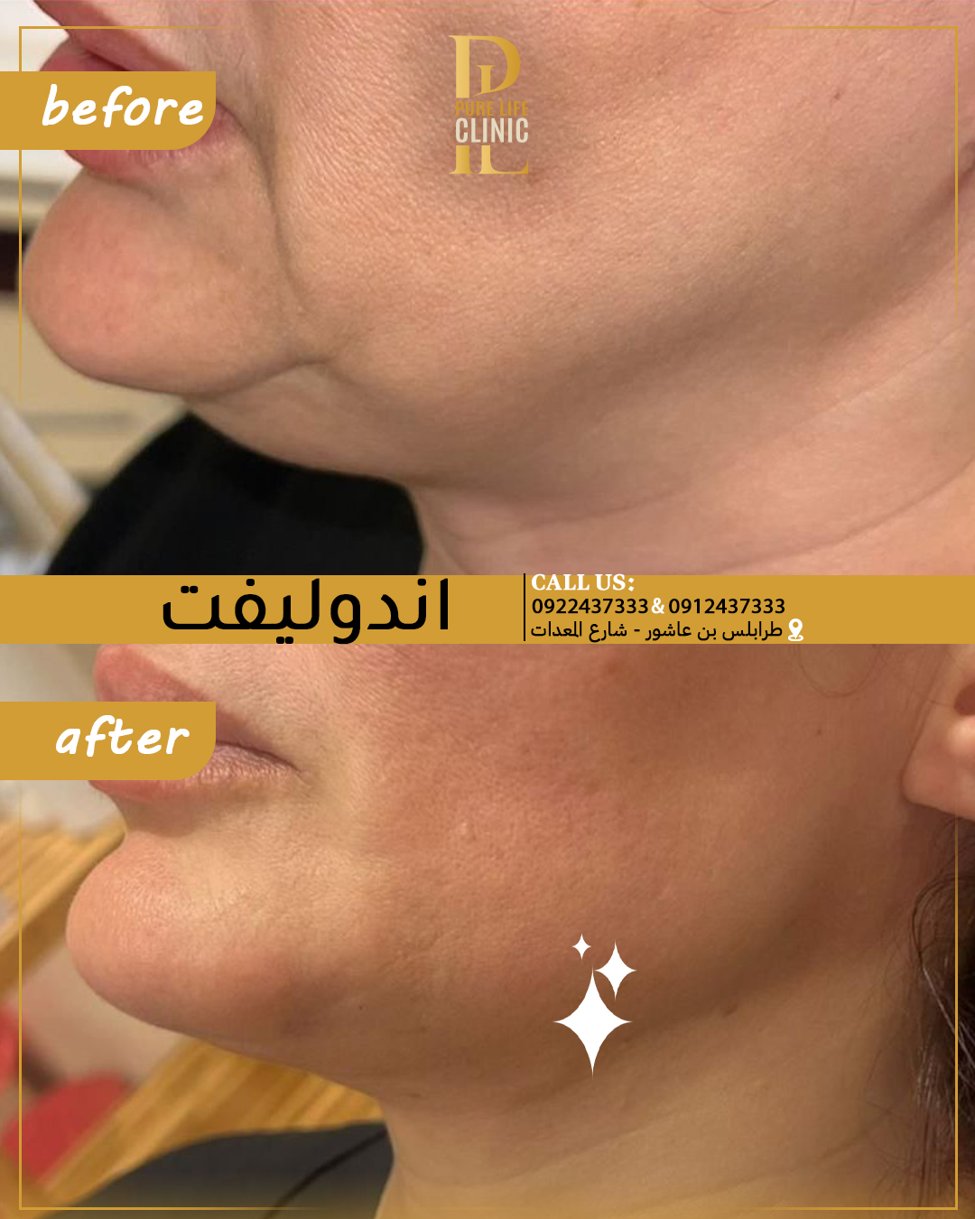 اندوليفت