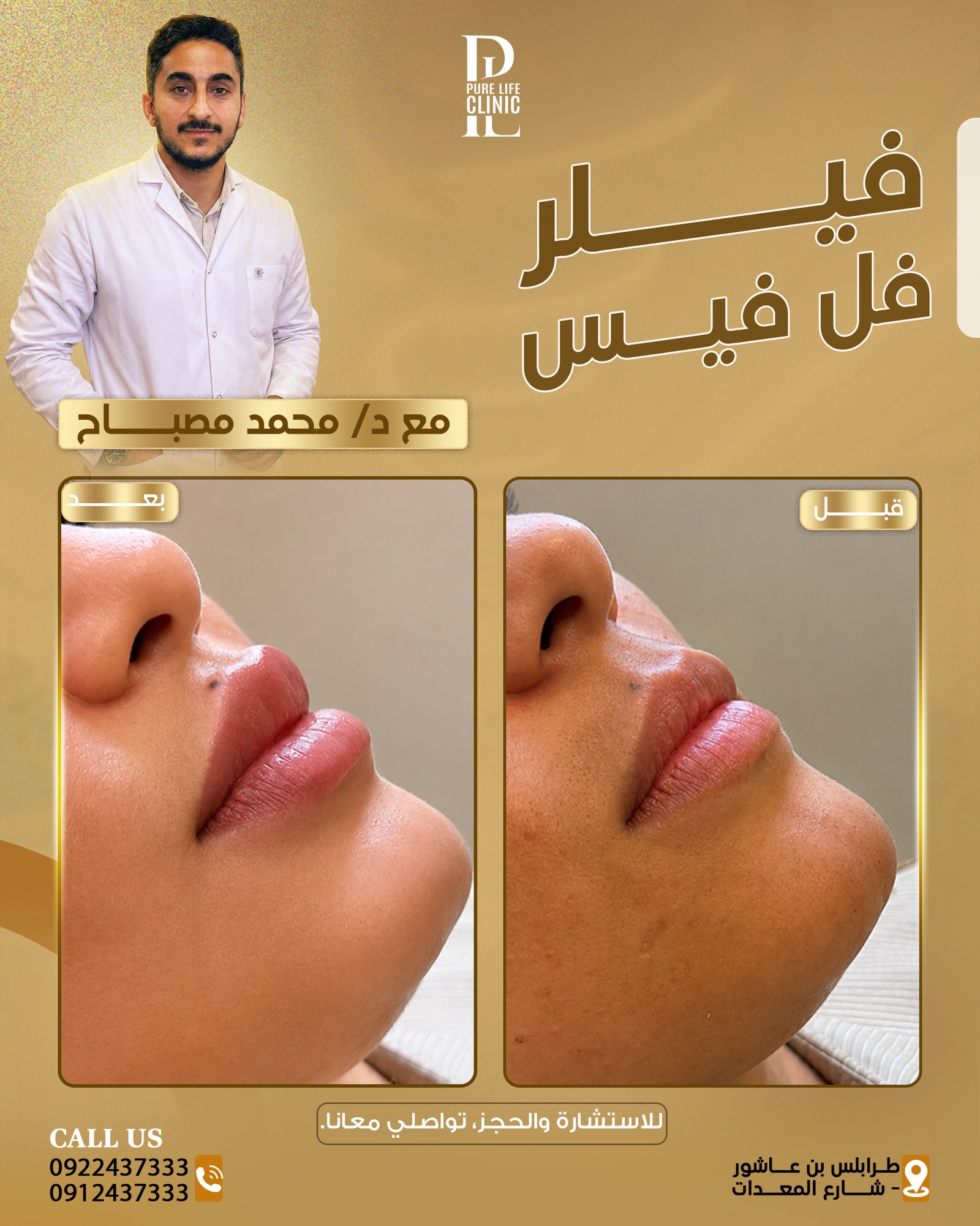 فيلر الشفاه لمظهر طبيعي ومتناسق