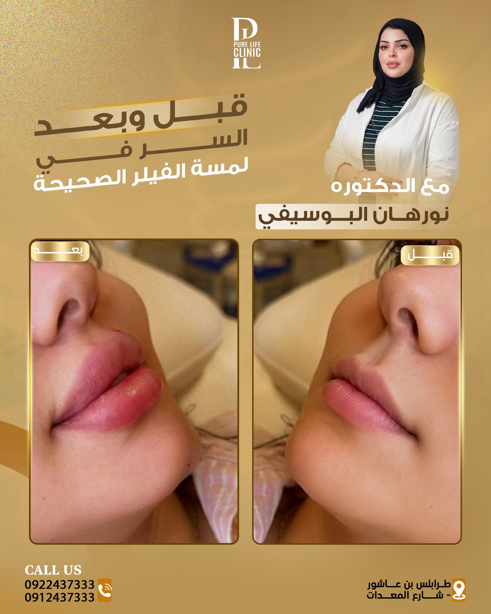 فيلر الشفاه وتناسق البروفايل الجانبي